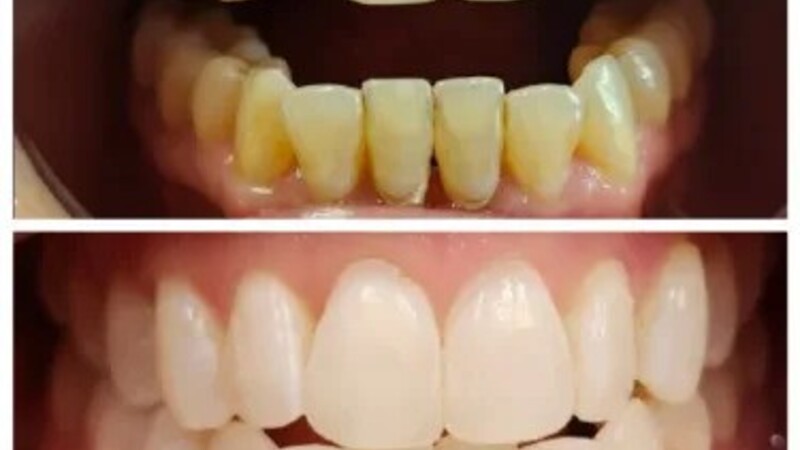 Achieve Your Dream Smile with Invisalign Burlington, NC Solutions