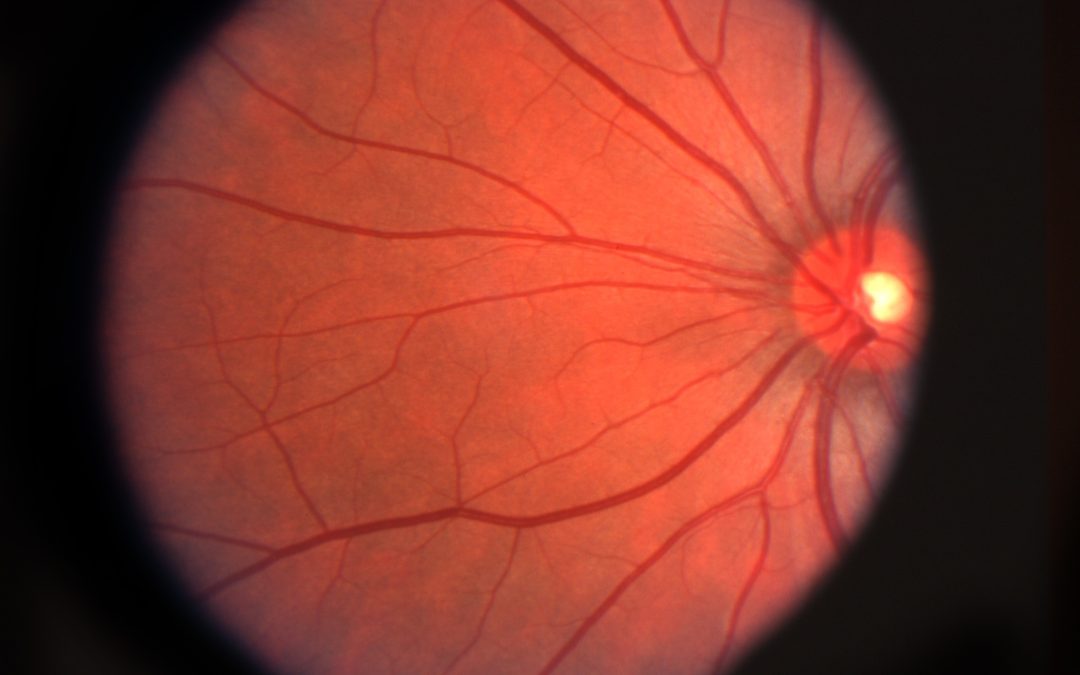 Addressing Vision Loss Through Macular Degeneration Treatment Boca Raton FL Options