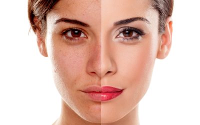 Look Younger and More Radiant with Skin Tightening Treatments at Luxe Beauty & Wellness on Tomball Pkwy